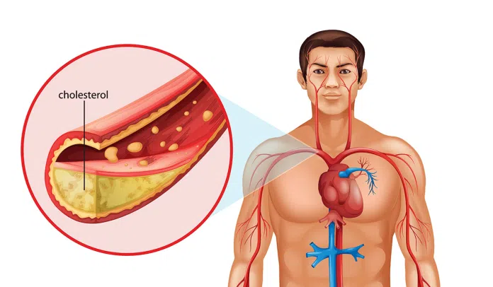 كيف تخفض مستويات الكوليسترول لديك؟
